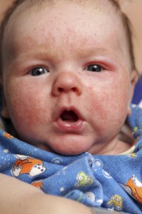 Infant with allergic diathesis