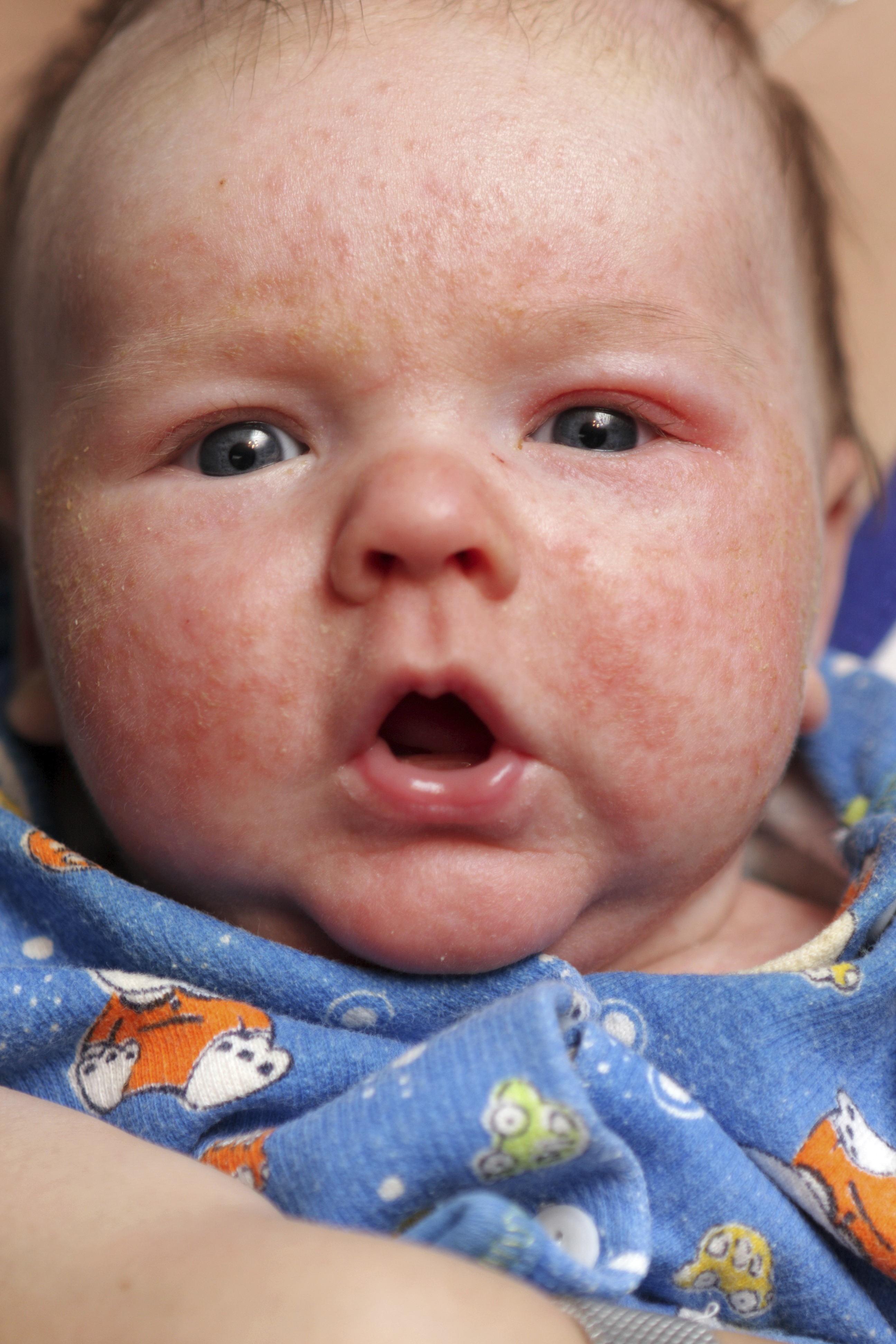 eczema treatment baby face